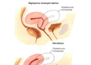 Ретрофлексия матки при беременности