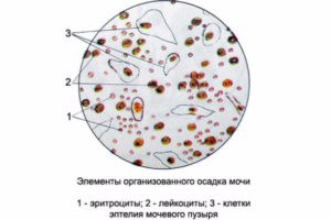 Эритроциты и лейкоциты в моче при беременности форум