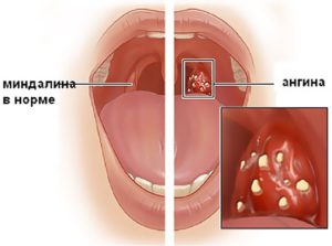 Болит горло 38 неделя беременности чем лечить