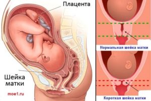 Шейка матки короткая при беременности 34 недели беременности