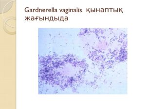 Gardnerella vaginalis при беременности