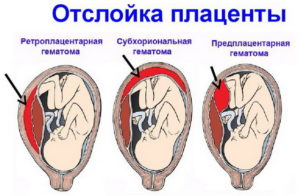 Отслойка плаценты и гематома на ранних сроках беременности