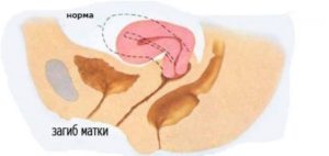 Матка отклонена кзади при беременности что это значит