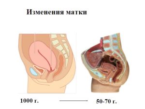 Что делать если матка после родов не сокращается