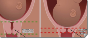 Шейка матки короткая при беременности 21 неделя беременности