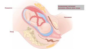 Обвитие пуповиной вокруг шеи на 32 неделе