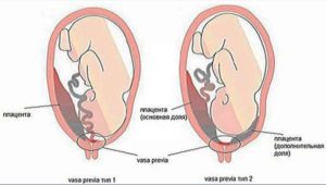 Низкое прикрепление плаценты при беременности 20 недель