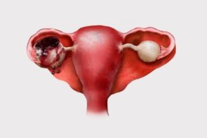 Киста яичника в менопаузе симптомы и лечение женщины