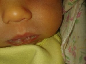Белая корочка на губах у новорожденных