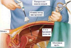 Болезненная овуляция после лапароскопии