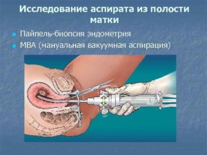 Аспирация из полости матки