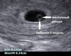 Если на 5 неделе беременности не видно эмбриона