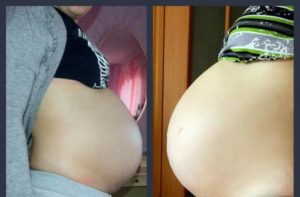 18 недель беременности каменеет живот