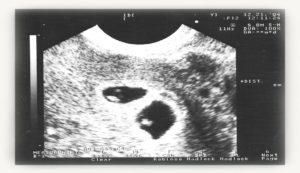 Небольшая отслойка плаценты на ранних сроках беременности форум