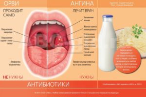 Болит горло 38 неделя беременности чем лечить