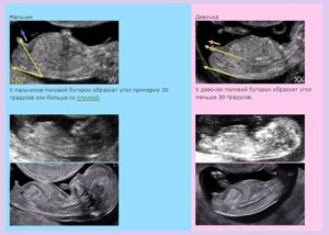На 13 недели беременности можно узнать пол ребенка