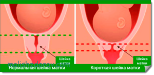 Что значит короткая шейка матки