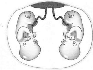 Беременность двойня диамниотическая двойня