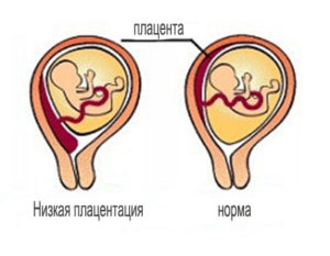 20 недель беременности низко расположена плацента при беременности