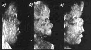 На каком сроке можно определить патологии плода