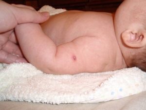 Прививка на руке при рождении