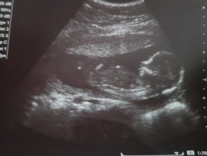 Беременность 17 недель двойня