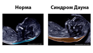 Можно ли на узи выявить дцп при беременности