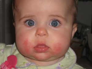 Почему красные щечки у ребенка