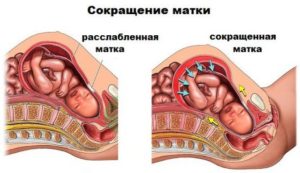 Напряженная матка при беременности