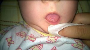 Белые пятна на губах у ребенка