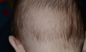 Ребенку 3 месяца выпадают волосы