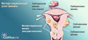 Интерстициальный узел по передней стенке матки при беременности