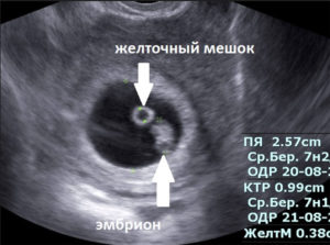 При каком хгч виден эмбрион на узи