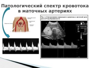 Снижение кровотока в левой маточной артерии при беременности