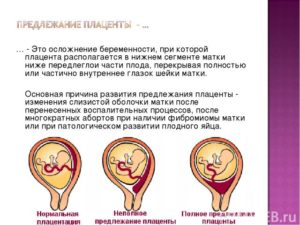 Низкая плацентация при беременности в 12 недель