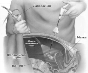 Болезненная овуляция после лапароскопии