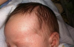 Ребенку 3 месяца выпадают волосы