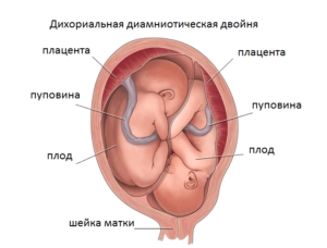 Беременность двойня диамниотическая двойня