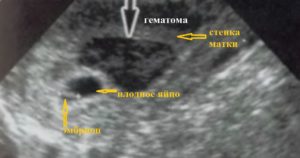 Ретроамниотическая гематома при беременности что это такое