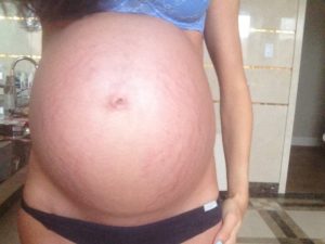 Как начинаются растяжки на животе при беременности
