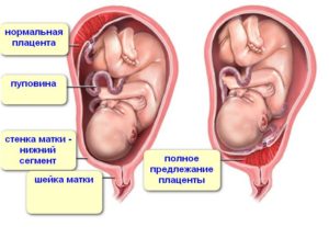 Плацента расположена по задней стенке в дне матки