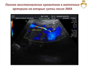 Снижение кровотока в левой маточной артерии при беременности