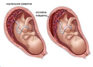 Утрожестан при отслойке плаценты на ранних сроках беременности