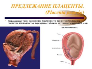 Нижний край плаценты перекрывает область внутреннего зева