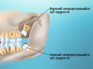 Зуб мудрости как долго растет