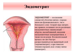 Воспаление матки после родов симптомы и лечение