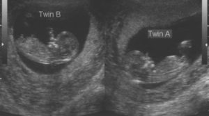 13 неделя беременности двойня