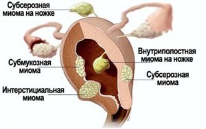 Интерстициальный узел по передней стенке матки при беременности