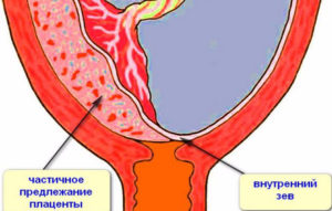 Плацента доходит до внутреннего зева не перекрывая его