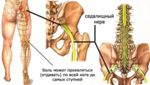 Защемление седалищного нерва у беременных симптомы и лечение